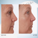 雙重分子透明質酸精華