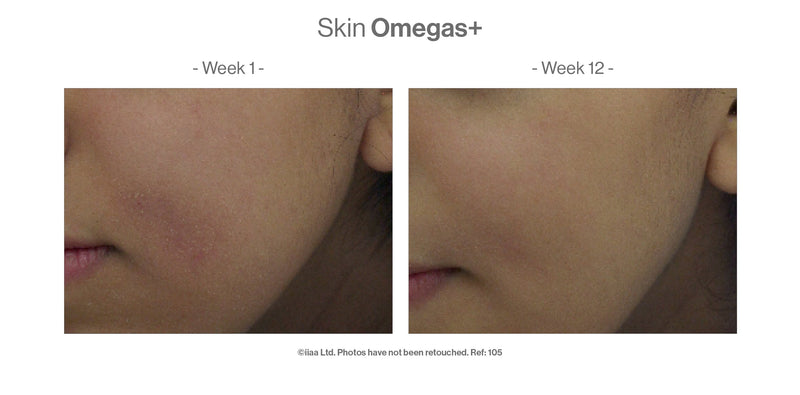 Eczema free「SKIN OMEGAS™+Skin Accumax™」