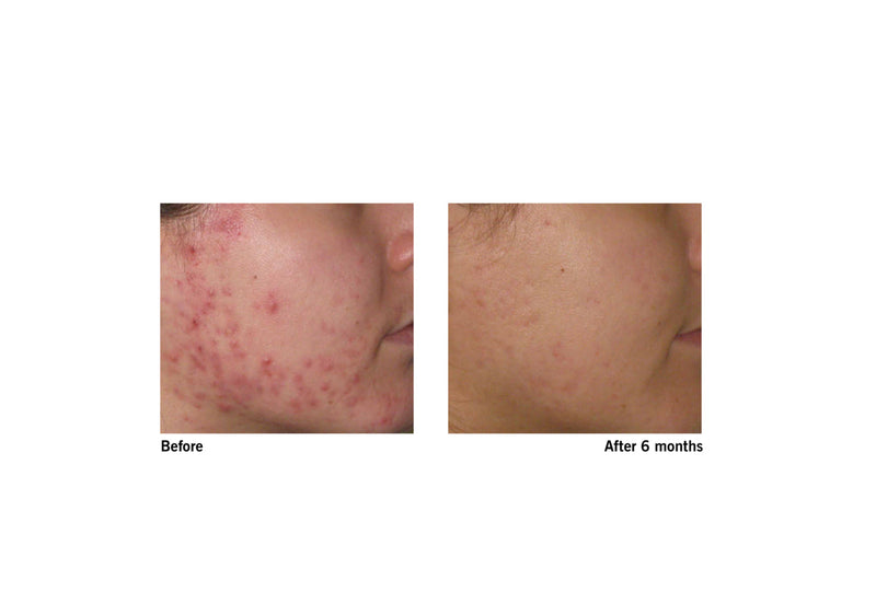 Eczema free「SKIN OMEGAS™+Skin Accumax™」